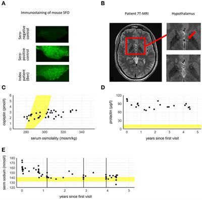 Case report: Psychosis and catatonia in an adolescent patient with adipsic hypernatremia and autoantibodies against the subfornical organ